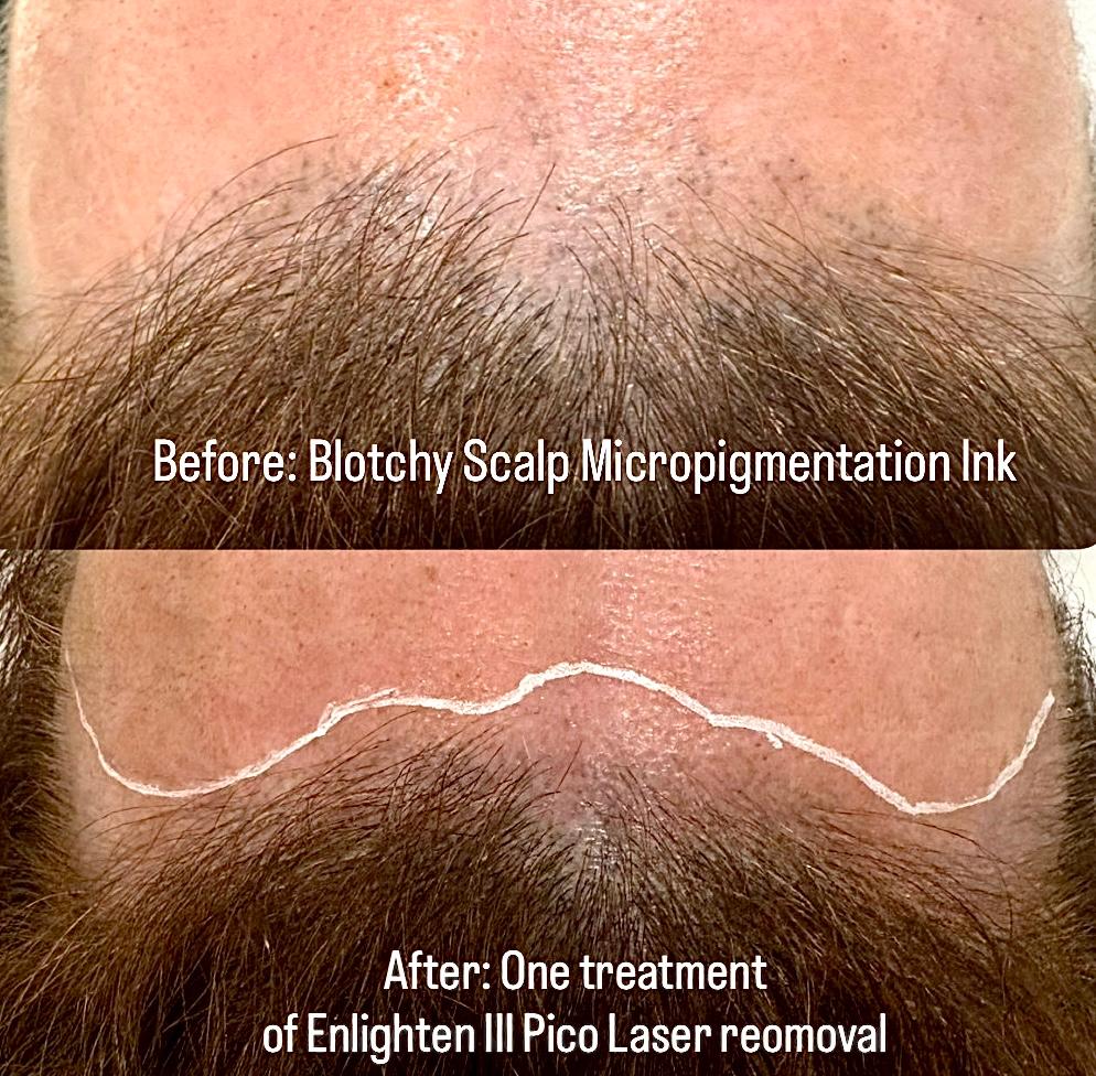 Laser Body Tattoo Removal before and after at Glowtique Brisbane